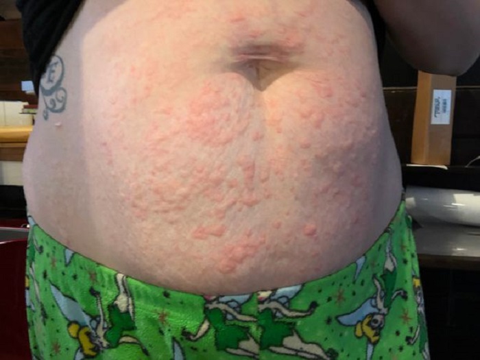 Суықта мүлде жүре алмайды: 26 жастағы бойжеткеннің суыққа аллергиясы бары анықталды