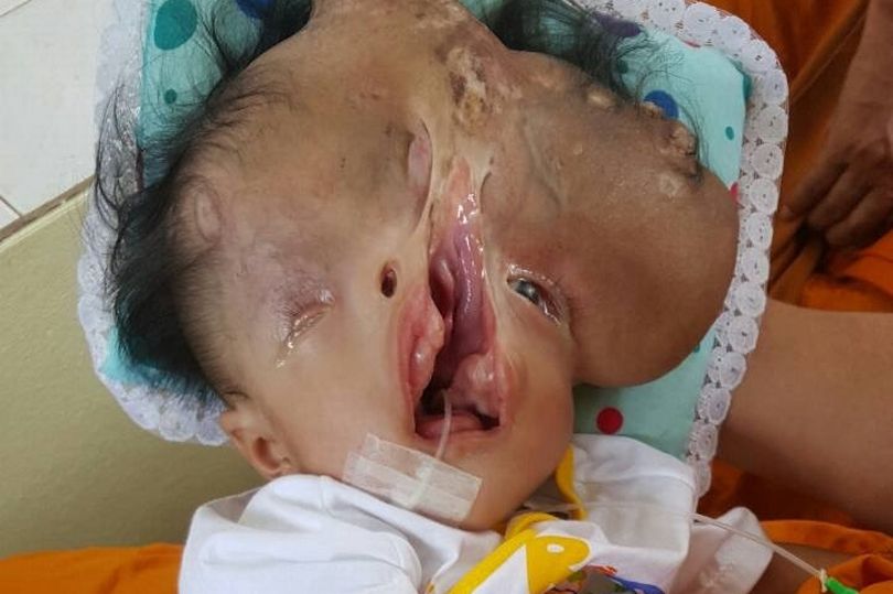 PAY-Severely-disabled-baby-gets-help