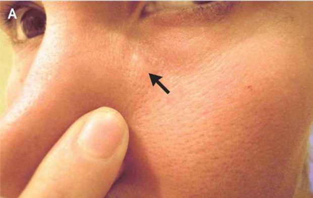 Жазғы Брилл