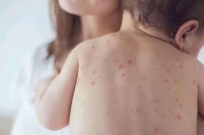 "Күн сайын шамамен 25 жағдай": Қазақстанда қызылша ауруы өршіді