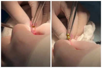 Шымкентте дәрігерлер үш жасар баланың асқазанынан 16 магнит алып шықты