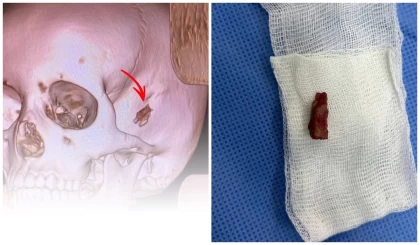 Қазақстанда 10 жастағы баланың басынан бес жыл бұрын кіріп кеткен бұтақтың бір бөлігі алынды