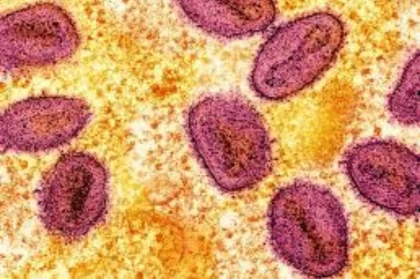 Үндістанда маймыл шешегінің жаңа қауіпті штаммы анықталды