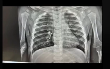 Ақтауда 11 айлық баланың өкпесінен шемішкенің қабығы табылды