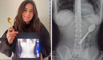 Бойжеткен абайсызда 17 сантиметрлік қасықты жұтып қойған