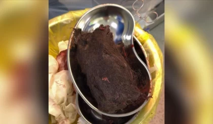 Түркістан облысында дәрігерлер жасөспірімнің асқазанынан салмағы 1 келі шаш алып шықты