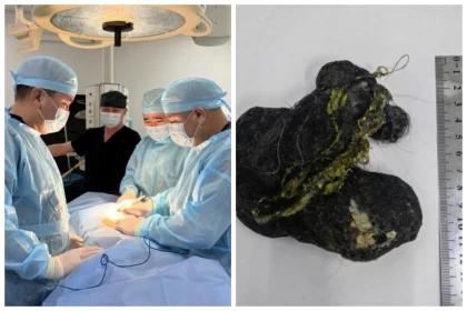 Шымкентте дәрігерлер баланың асқазанынан бір уыс шаш алып шықты