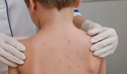 Денсаулық сақтау министрі қазақстандықтарды балаларды қызылшадан қорғауға шақырды