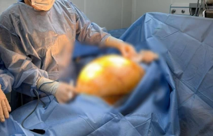 БАД ішіп емделмек болған: Алматылық әйелдің денесінен салмағы 25 келі болатын қатерлі ісік алынды