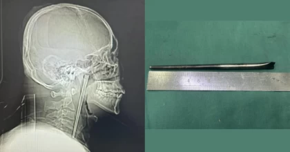 Ер адам 8 жыл бойы тамағында темір таяқшамен жүрген