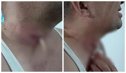 Ақтөбе тұрғыны дәрігерлер ұмытып кеткен дәкені тамағынан өз бетінше суырып шығарған (видео)