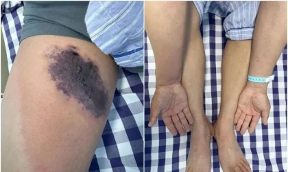 Ер адам ескі джинсы шалбарын киген соң ауруханаға түсті