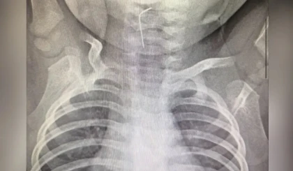 Түркістан облысында тоғыз айлық сәби ине жұтып қойған