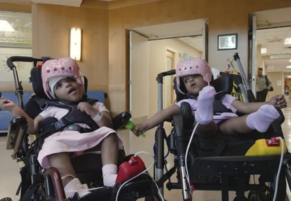 Басы бірігіп туған сиам егіздері сәтті ажыратылды
