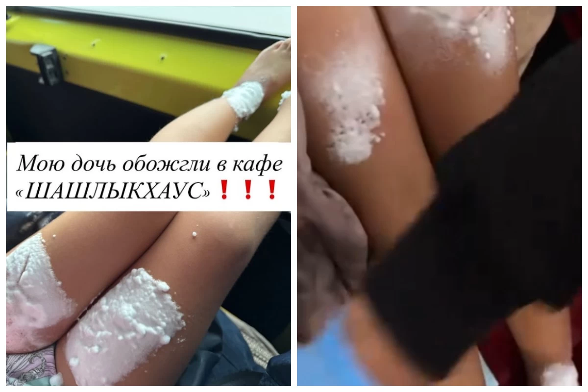 ІІІ дәрежелі күйік алған