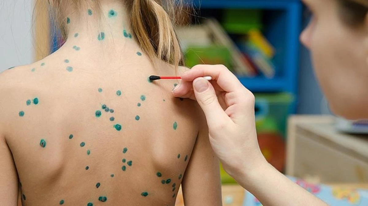 ветрянка желшешек