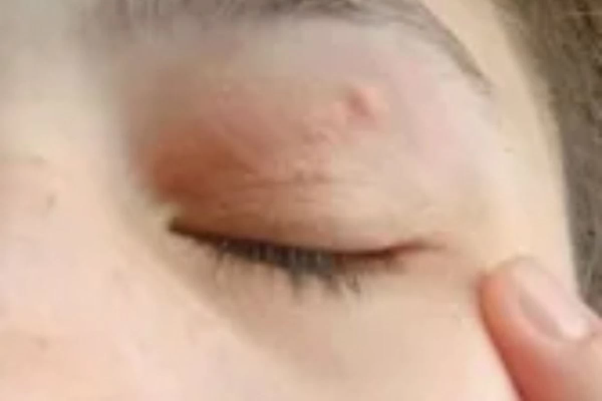 Румыниялық қыздың көзінің астынан паразит алынды