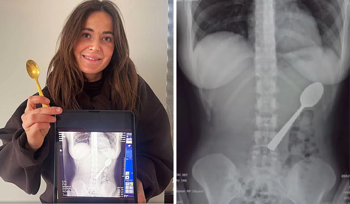 Бойжеткен абайсызда 17 сантиметрлік қасықты жұтып қойған