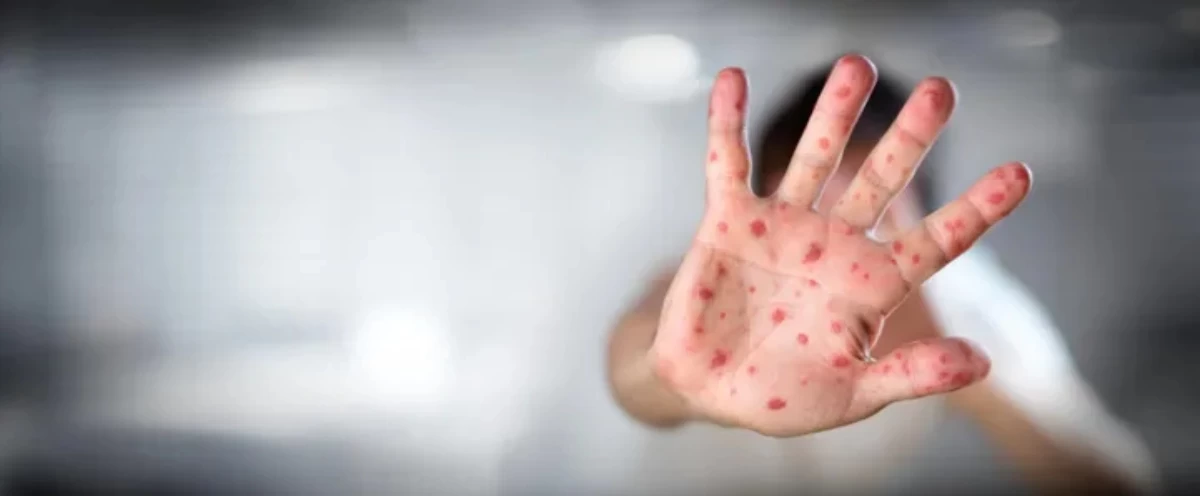 Фото_ Shutterstock қызылша корь