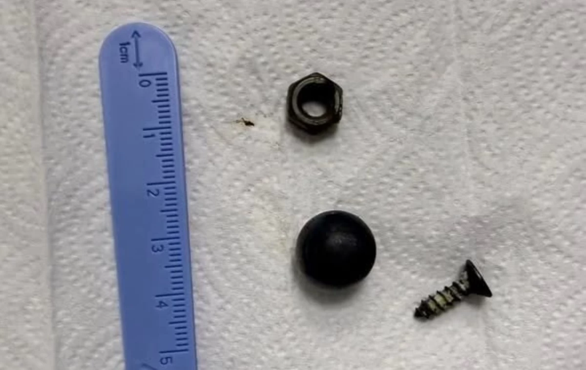 Дәрігерлер баланың ішегінен магнит пен бұранда алып шықты