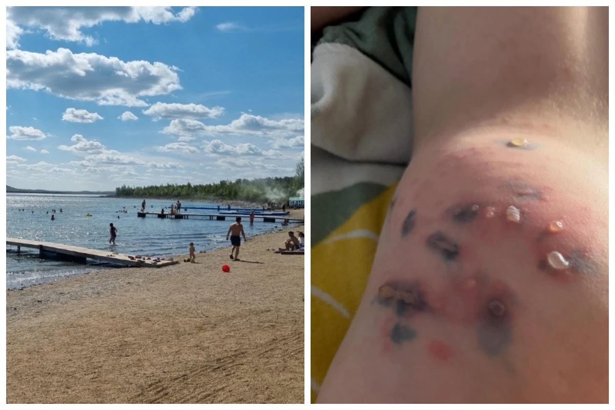 Бурабай су инфекция бала