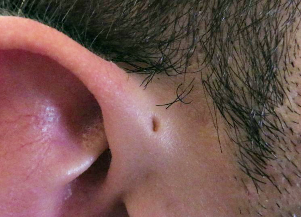 Preauricular-sinus-Ear-hole