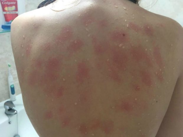 Аллергия үшін: Дәрігерлер 19 жастағы бойжеткенге жылауға тыйым салды