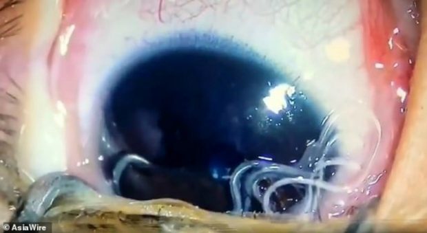 Дәрігерлер 5 айлық сәбидің көзінен оннан аса тірі құртты алып шықты (видео)